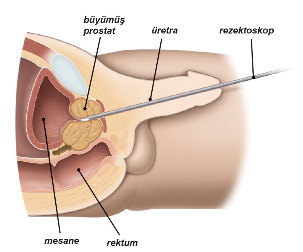 kapalı prostat ameliyatı